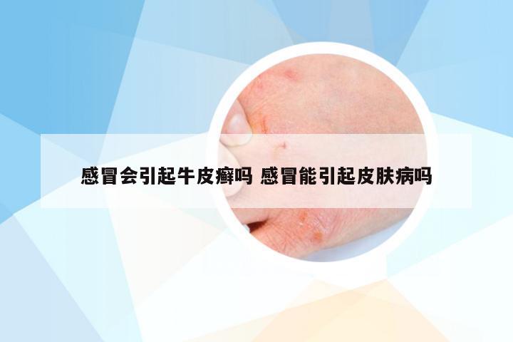 感冒会引起牛皮癣吗 感冒能引起皮肤病吗