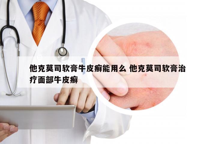 他克莫司软膏牛皮癣能用么 他克莫司软膏治疗面部牛皮癣