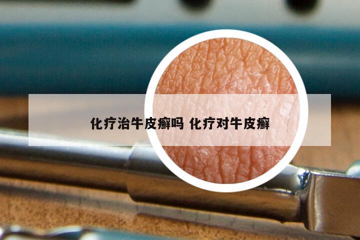 化疗治牛皮癣吗 化疗对牛皮癣
