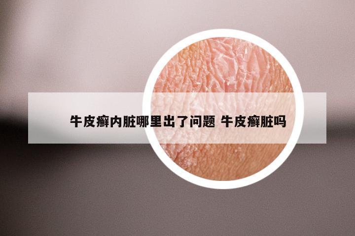 牛皮癣内脏哪里出了问题 牛皮癣脏吗