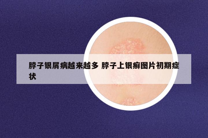 脖子银屑病越来越多 脖子上银癣图片初期症状