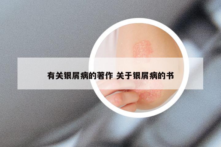 有关银屑病的著作 关于银屑病的书