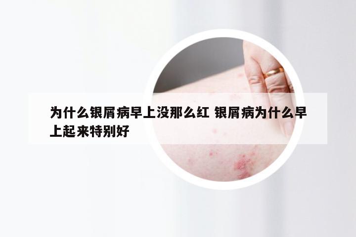 为什么银屑病早上没那么红 银屑病为什么早上起来特别好
