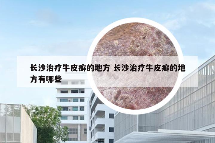 长沙治疗牛皮癣的地方 长沙治疗牛皮癣的地方有哪些