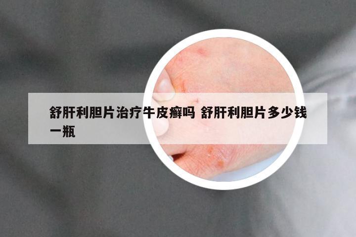 舒肝利胆片治疗牛皮癣吗 舒肝利胆片多少钱一瓶