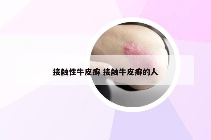 接触性牛皮癣 接触牛皮癣的人
