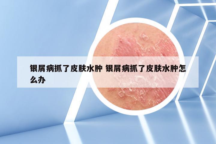 银屑病抓了皮肤水肿 银屑病抓了皮肤水肿怎么办