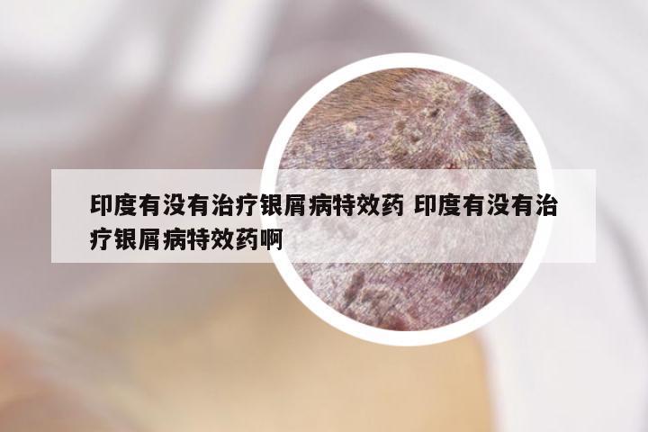 印度有没有治疗银屑病特效药 印度有没有治疗银屑病特效药啊