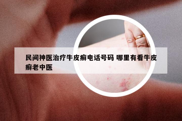 民间神医治疗牛皮癣电话号码 哪里有看牛皮癣老中医