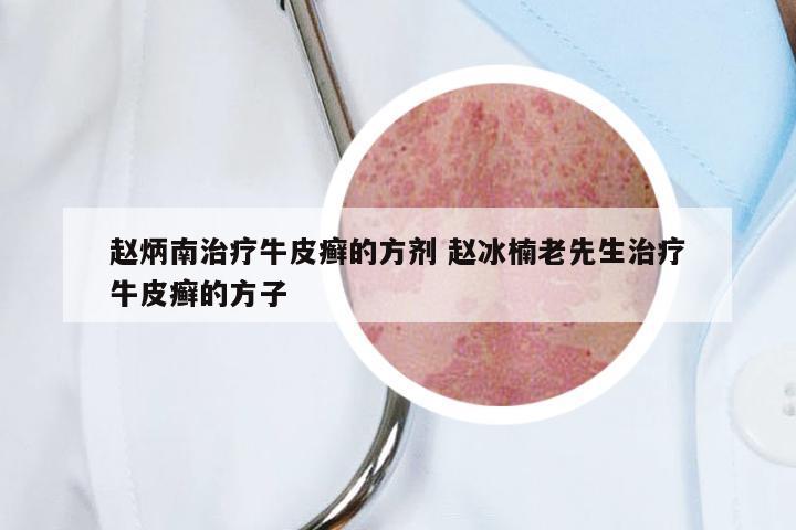 赵炳南治疗牛皮癣的方剂 赵冰楠老先生治疗牛皮癣的方子