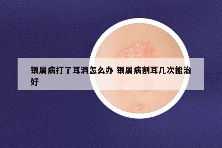 银屑病打了耳洞怎么办 银屑病割耳几次能治好