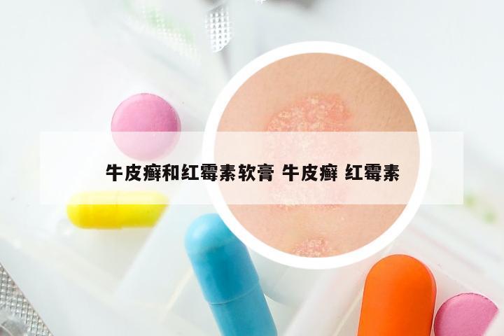 牛皮癣和红霉素软膏 牛皮癣 红霉素