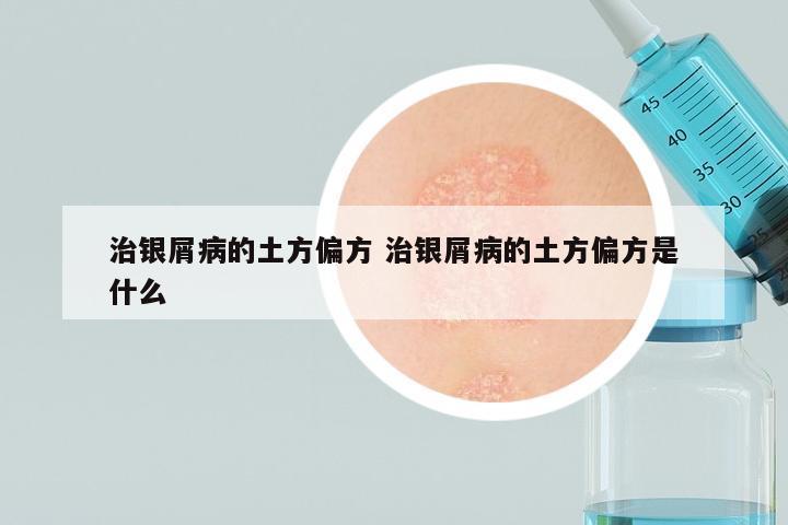 治银屑病的土方偏方 治银屑病的土方偏方是什么