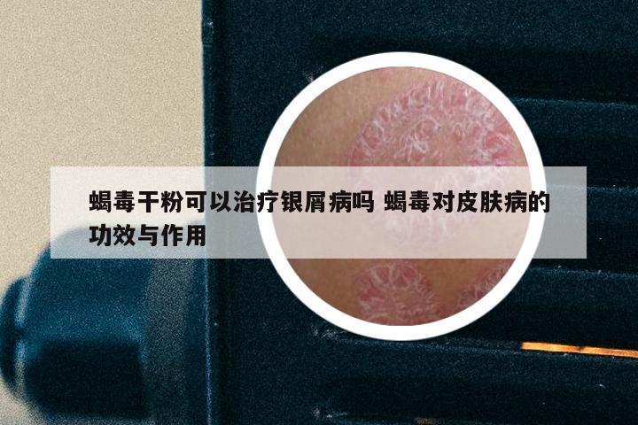 蝎毒干粉可以治疗银屑病吗 蝎毒对皮肤病的功效与作用