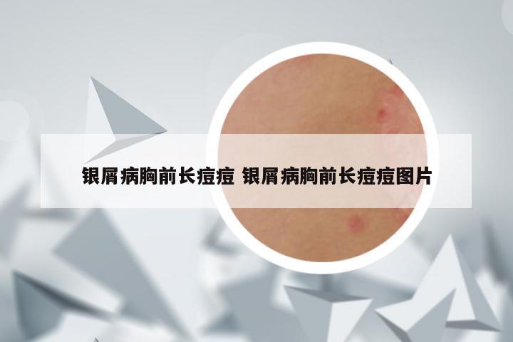 银屑病胸前长痘痘 银屑病胸前长痘痘图片