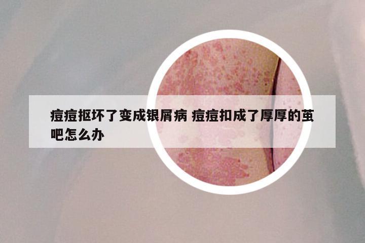 痘痘抠坏了变成银屑病 痘痘扣成了厚厚的茧吧怎么办