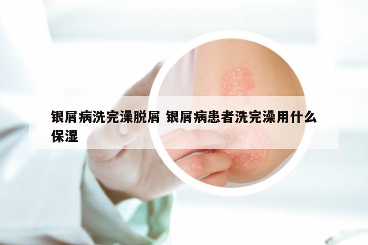 银屑病洗完澡脱屑 银屑病患者洗完澡用什么保湿
