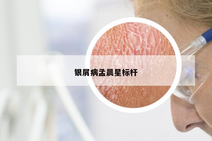 银屑病孟晨星标杆