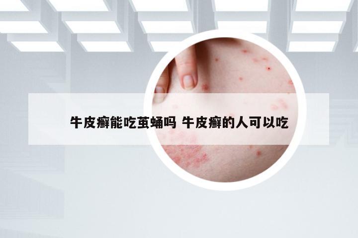 牛皮癣能吃茧蛹吗 牛皮癣的人可以吃
