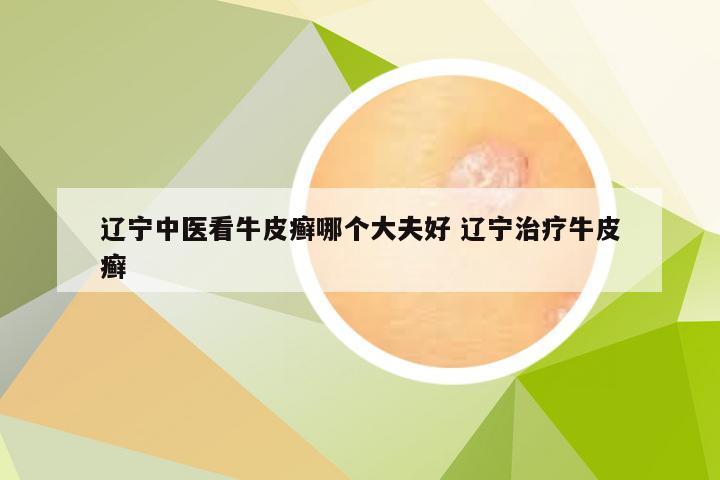 辽宁中医看牛皮癣哪个大夫好 辽宁治疗牛皮癣