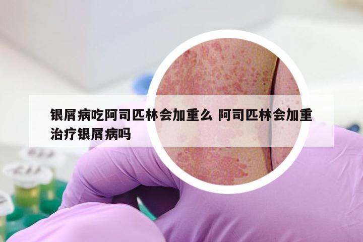 银屑病吃阿司匹林会加重么 阿司匹林会加重治疗银屑病吗
