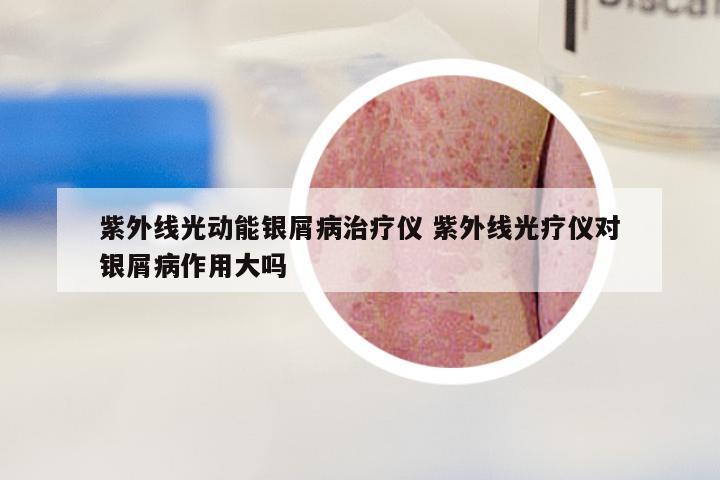 紫外线光动能银屑病治疗仪 紫外线光疗仪对银屑病作用大吗