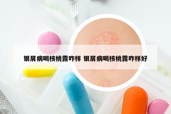 银屑病喝核桃露咋样 银屑病喝核桃露咋样好