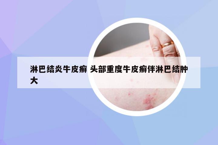 淋巴结炎牛皮癣 头部重度牛皮癣伴淋巴结肿大
