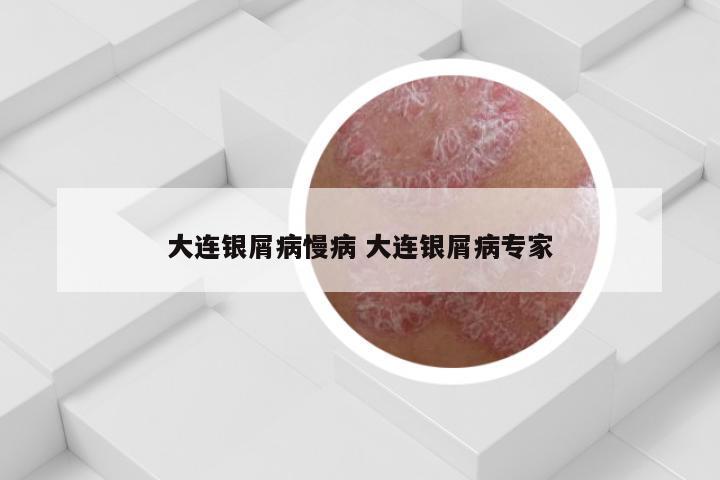 大连银屑病慢病 大连银屑病专家