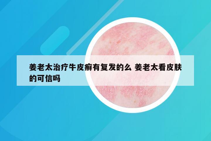 姜老太治疗牛皮癣有复发的么 姜老太看皮肤的可信吗