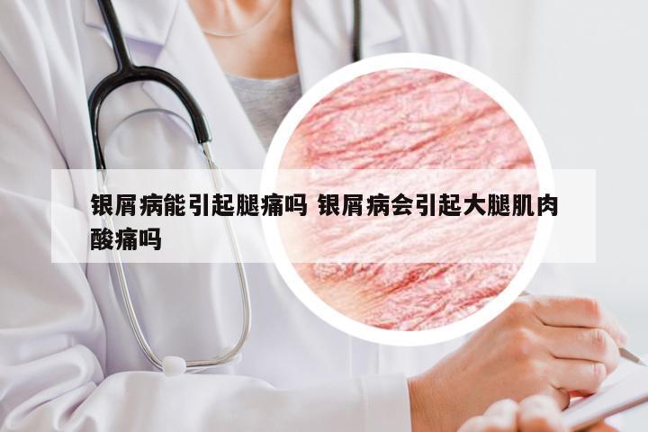 银屑病能引起腿痛吗 银屑病会引起大腿肌肉酸痛吗