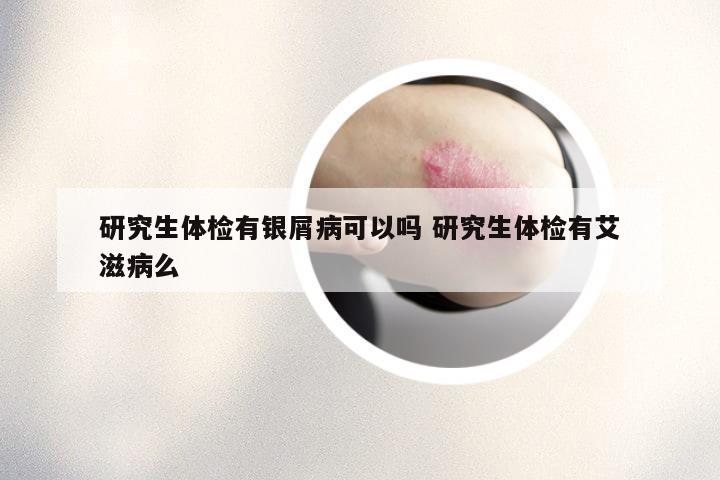 研究生体检有银屑病可以吗 研究生体检有艾滋病么