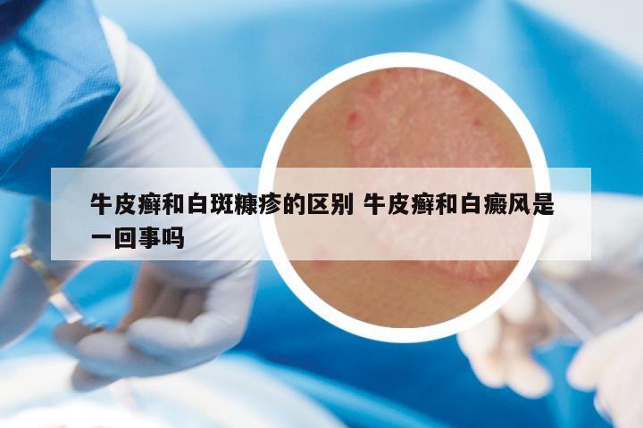 牛皮癣和白斑糠疹的区别 牛皮癣和白癜风是一回事吗