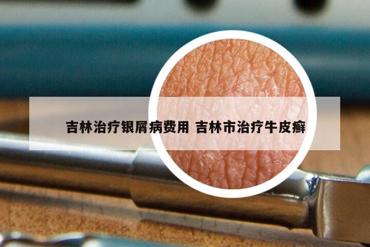 吉林治疗银屑病费用 吉林市治疗牛皮癣