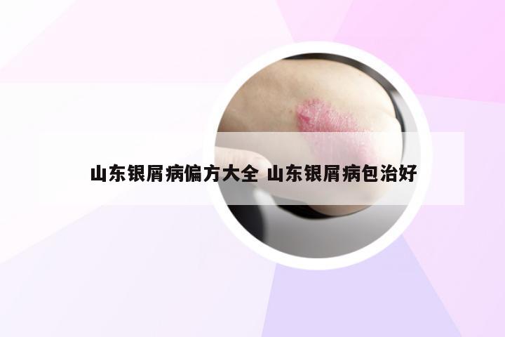 山东银屑病偏方大全 山东银屑病包治好