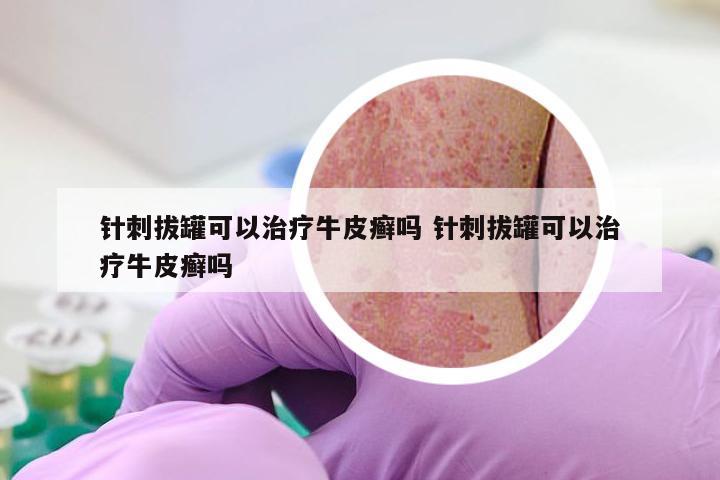 针刺拔罐可以治疗牛皮癣吗 针刺拔罐可以治疗牛皮癣吗