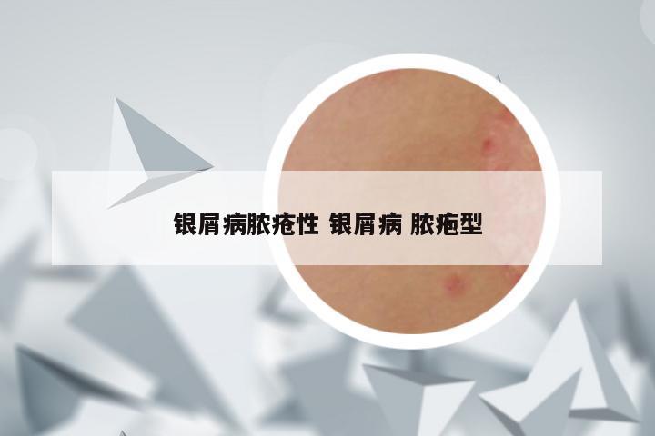 银屑病脓疮性 银屑病 脓疱型