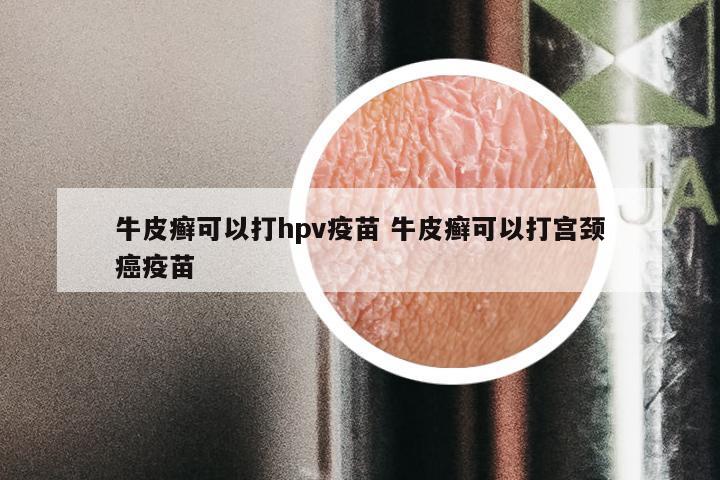 牛皮癣可以打hpv疫苗 牛皮癣可以打宫颈癌疫苗
