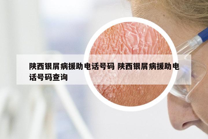 陕西银屑病援助电话号码 陕西银屑病援助电话号码查询
