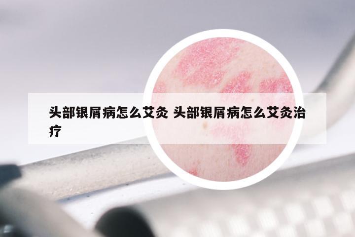 头部银屑病怎么艾灸 头部银屑病怎么艾灸治疗