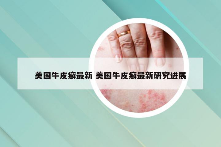 美国牛皮癣最新 美国牛皮癣最新研究进展