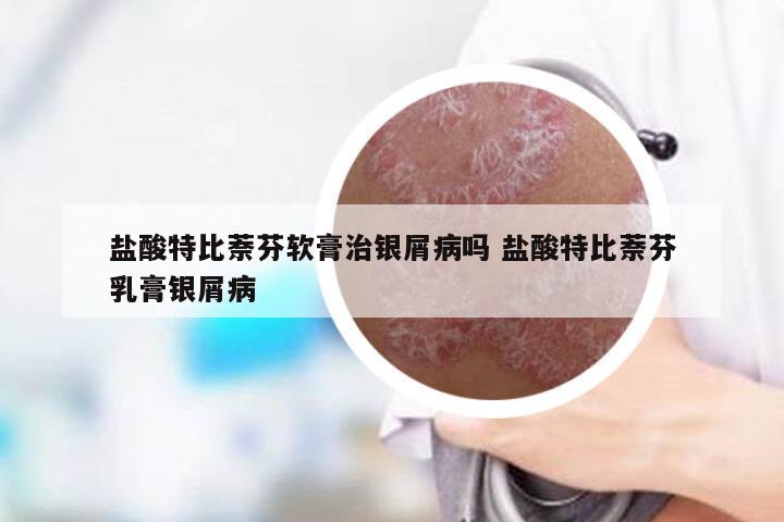 盐酸特比萘芬软膏治银屑病吗 盐酸特比萘芬乳膏银屑病
