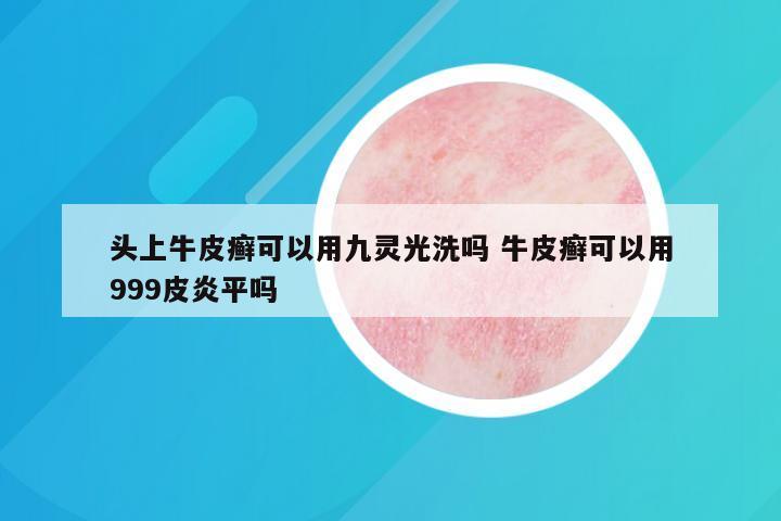 头上牛皮癣可以用九灵光洗吗 牛皮癣可以用999皮炎平吗