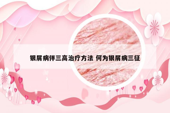 银屑病伴三高治疗方法 何为银屑病三征