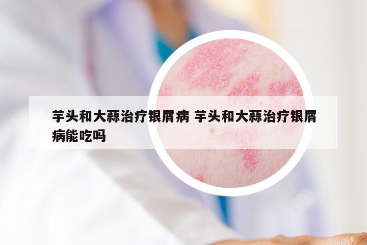 芋头和大蒜治疗银屑病 芋头和大蒜治疗银屑病能吃吗