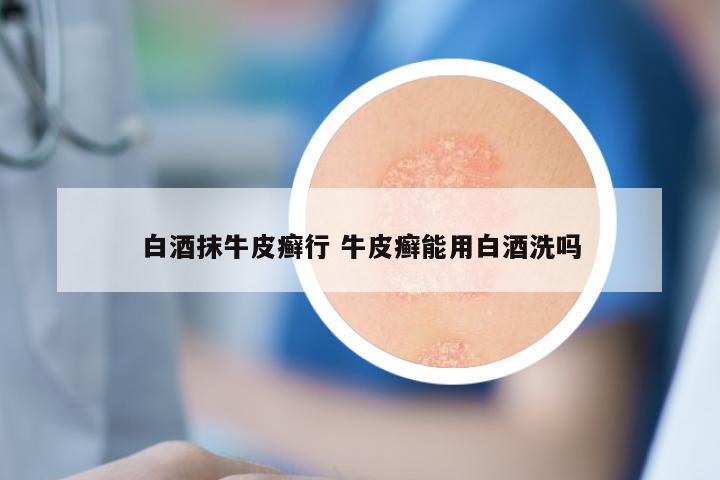 白酒抹牛皮癣行 牛皮癣能用白酒洗吗