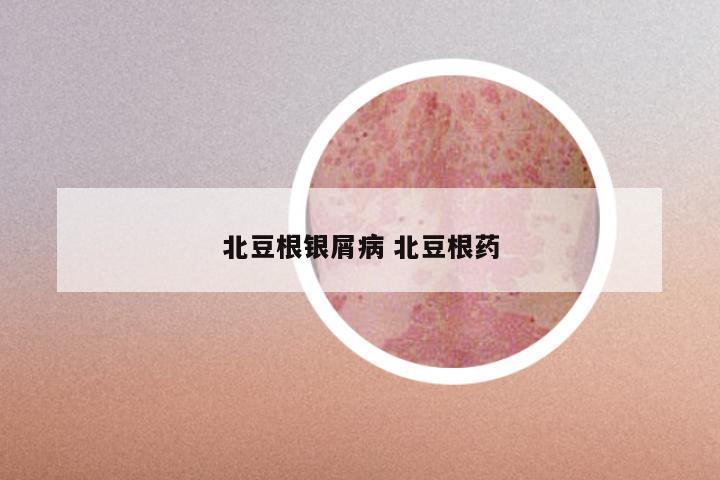 北豆根银屑病 北豆根药
