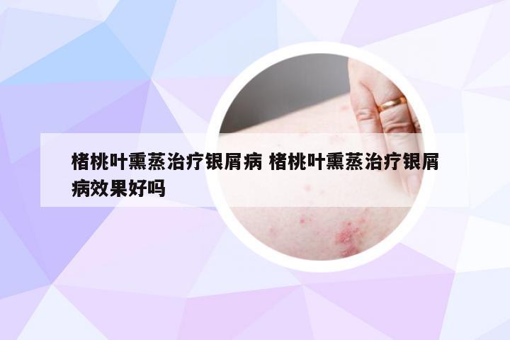 楮桃叶熏蒸治疗银屑病 楮桃叶熏蒸治疗银屑病效果好吗