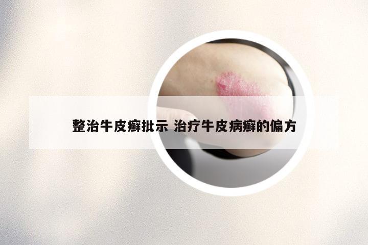 整治牛皮癣批示 治疗牛皮病癣的偏方