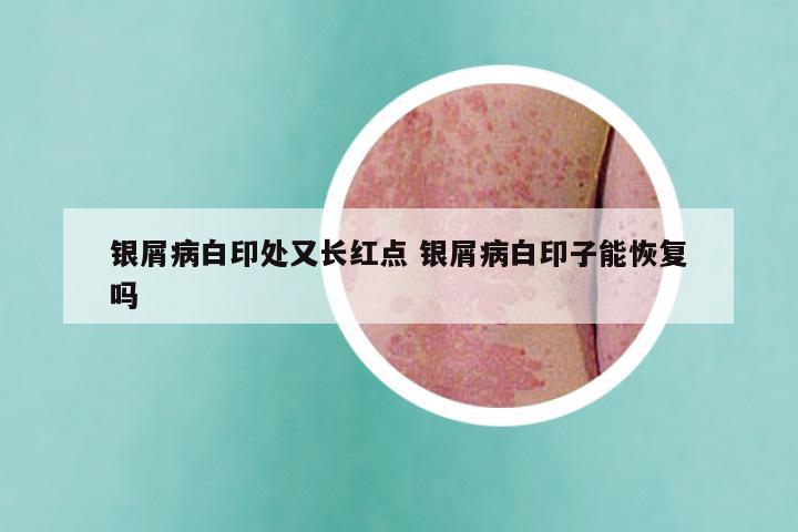 银屑病白印处又长红点 银屑病白印子能恢复吗
